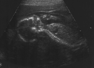 Triplets and Us - Learn all about our triplets. 21 Week ...